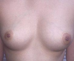 Areola Repigmentation by Deanna Lien - Artistry Of Permanent Makeup of Orange County