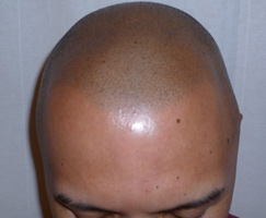 Scalp Micropigmentation by Artistry Of Permanent Makeup of Orange County